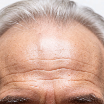 Wrinkles & Fine Lines 
