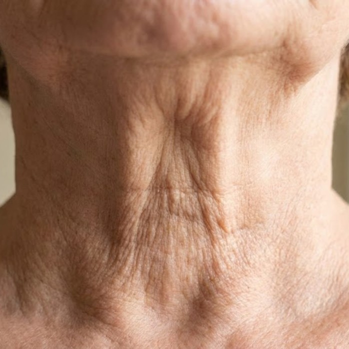 My neck is crepey and saggy (turkey neck)