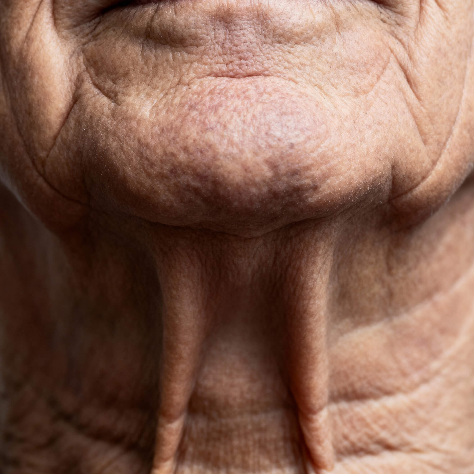 Saggy Skin