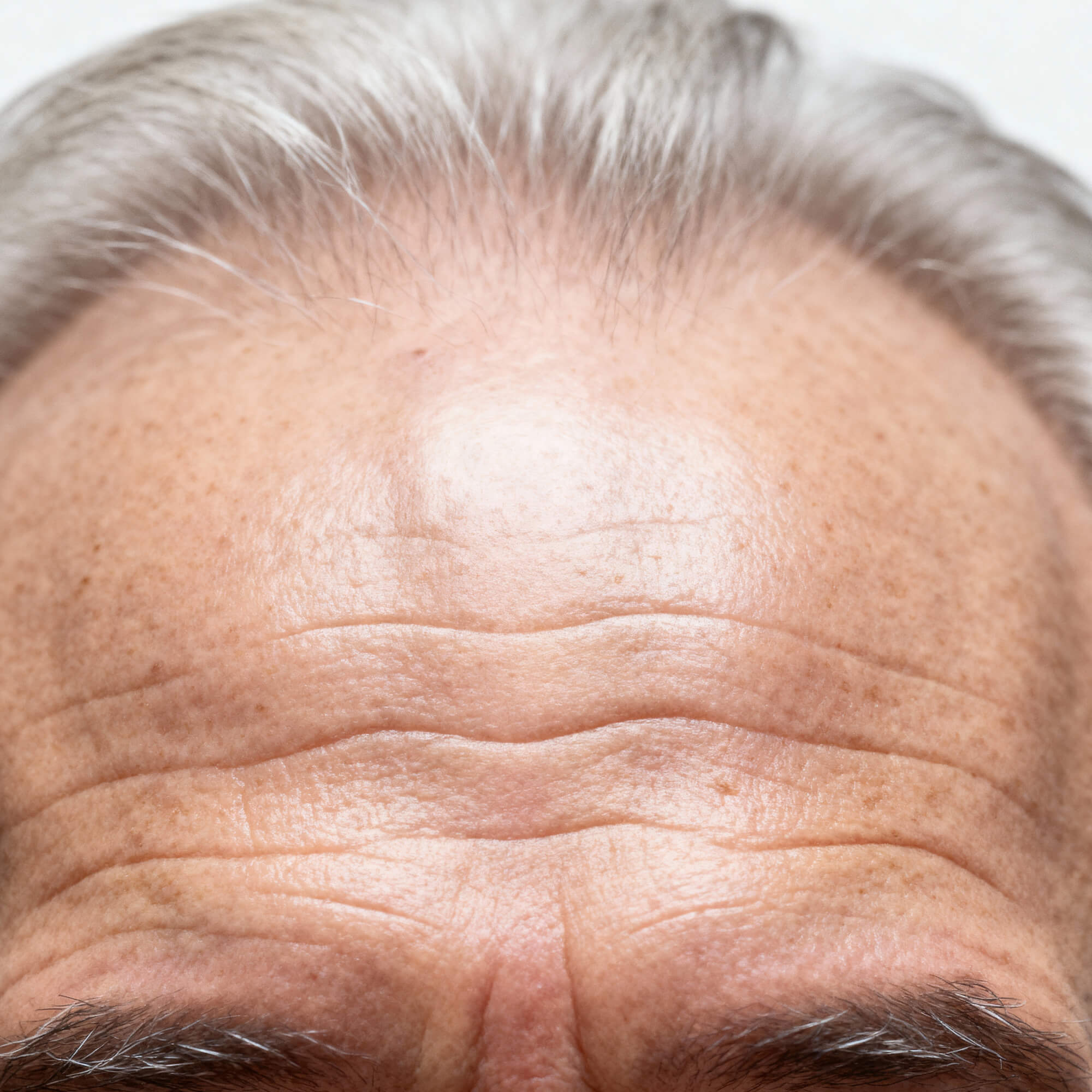 Wrinkles & Fine Lines