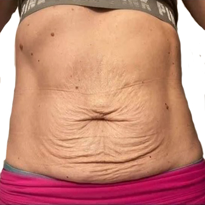 Mild Loose Skin