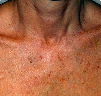 Chest/décolletage