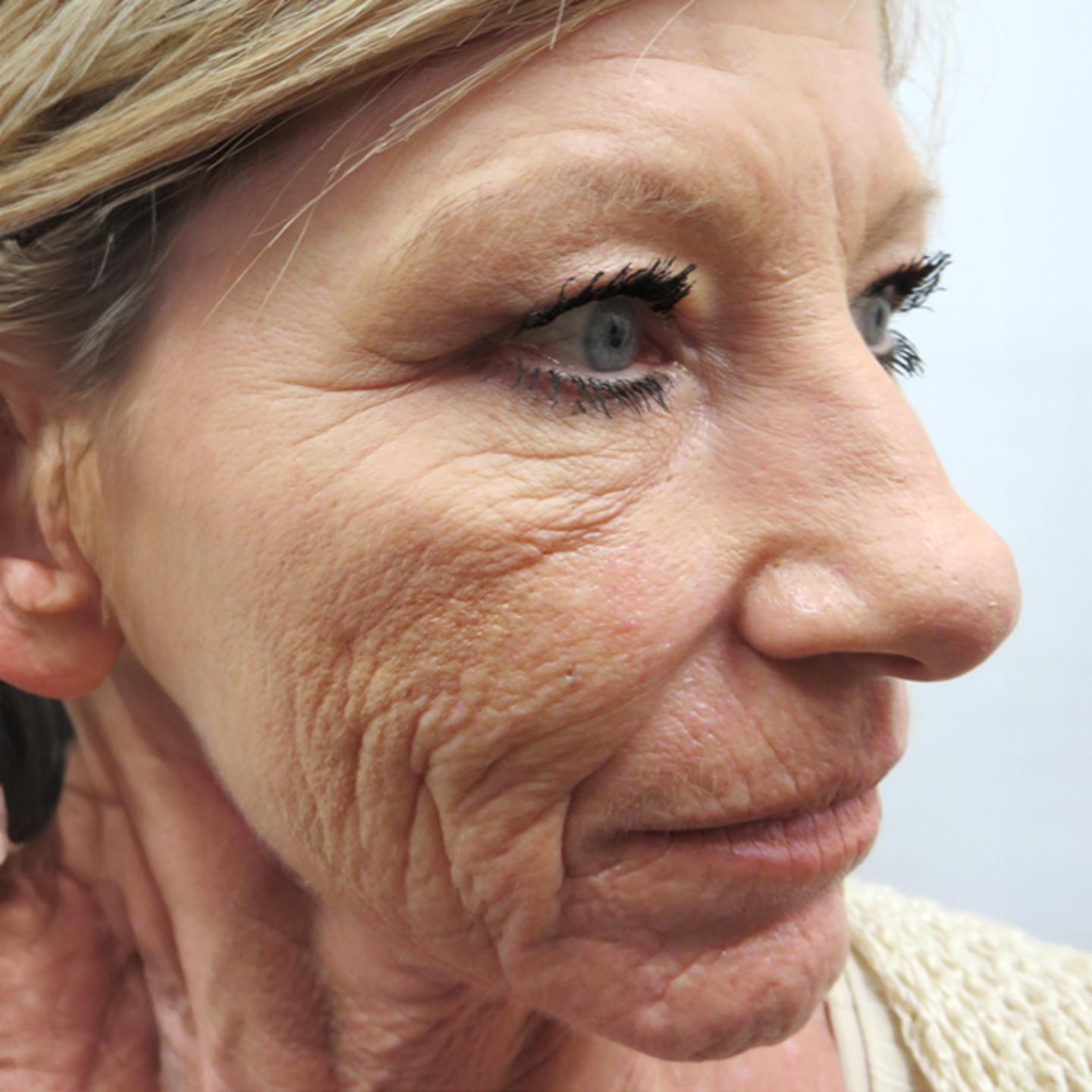 Fine lines and Wrinkles