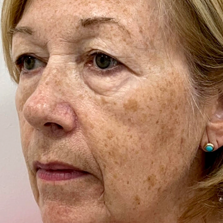 Uneven tone or dark spots