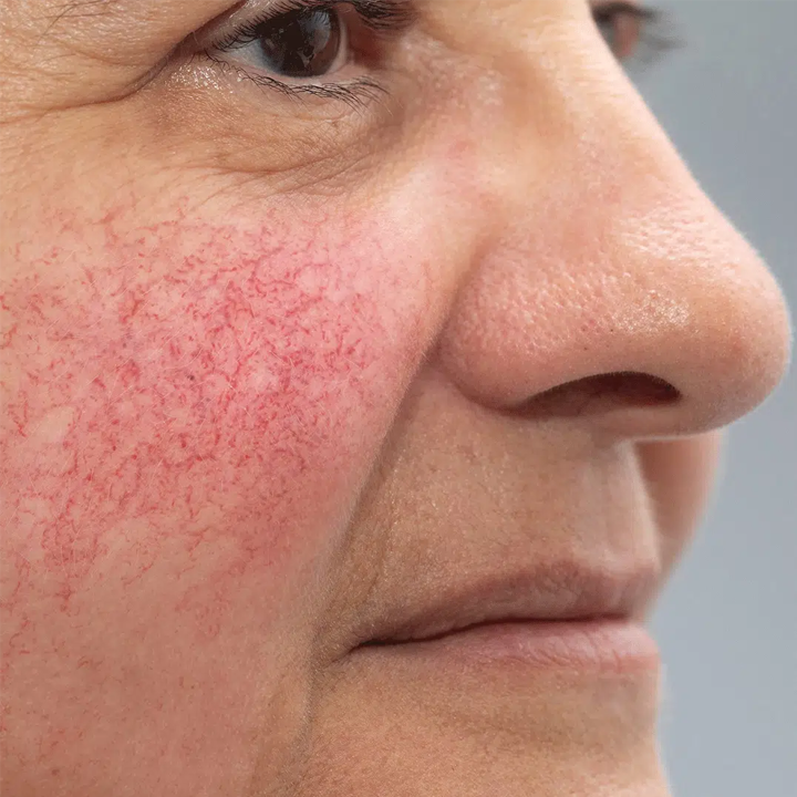 Redness or sensitivity