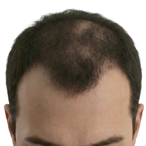Moderate thinning
