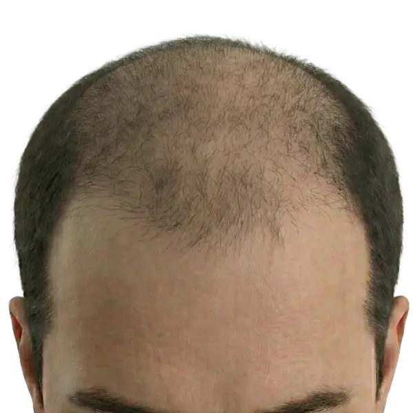 Advanced balding