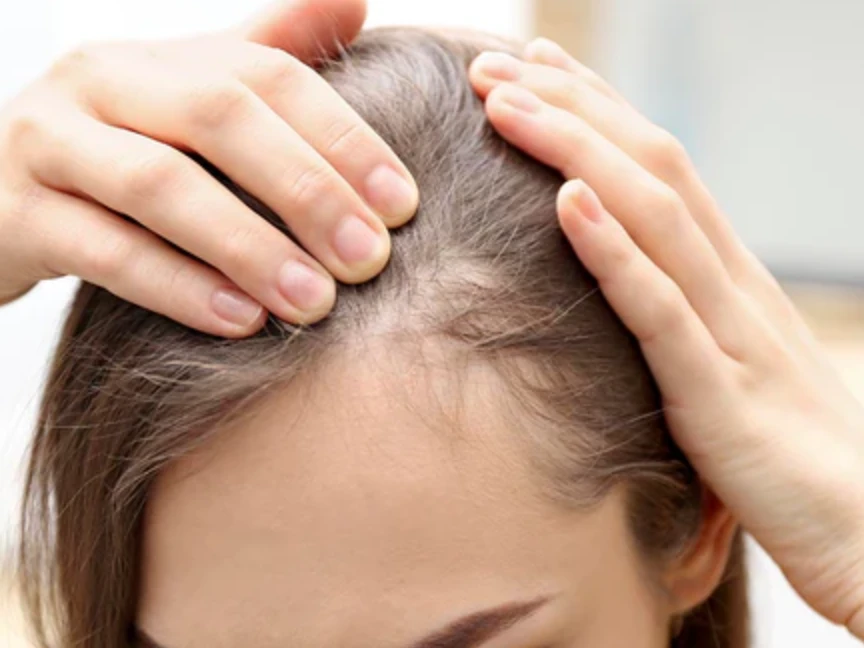 Thinning at the hairline