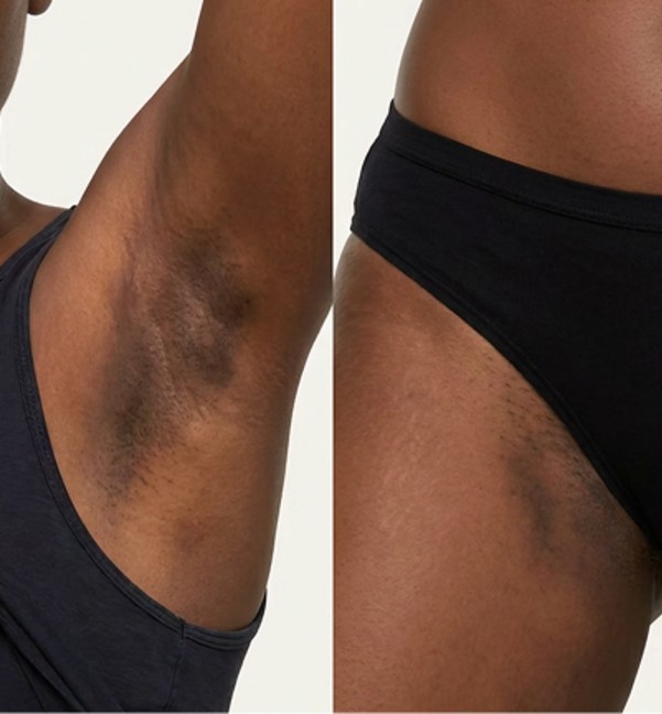 Dark Body Patches