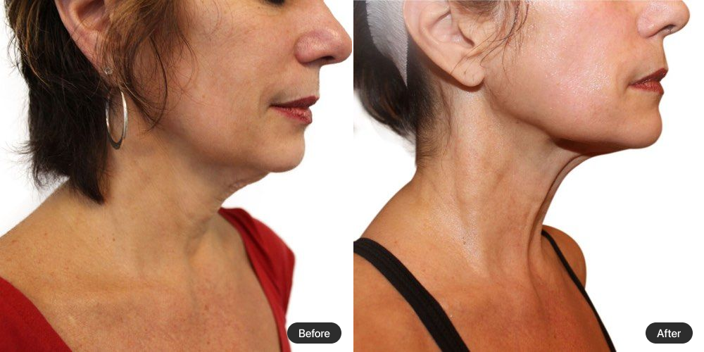 Before and After 3