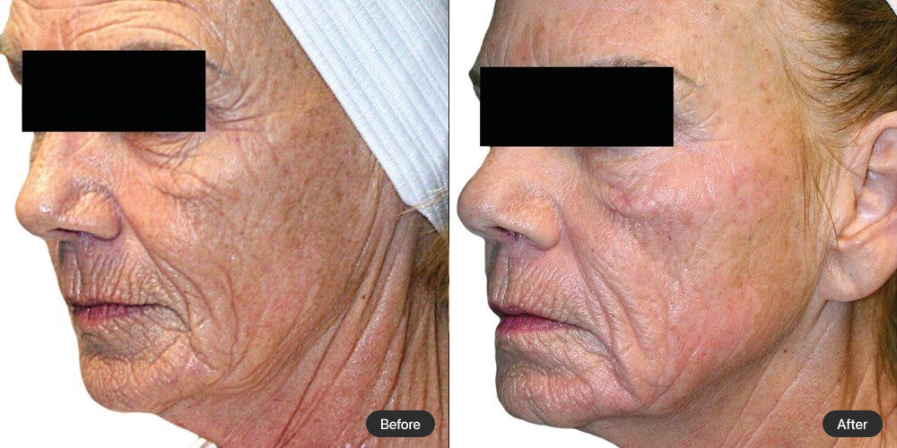 Before and After 2