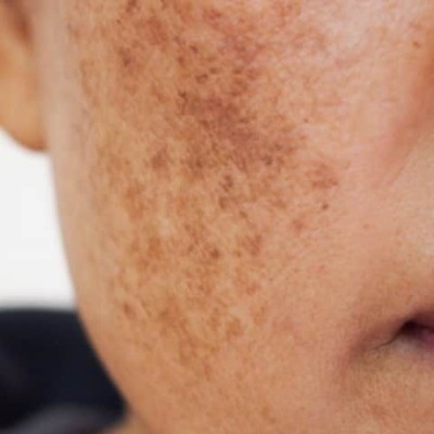 Dark spots