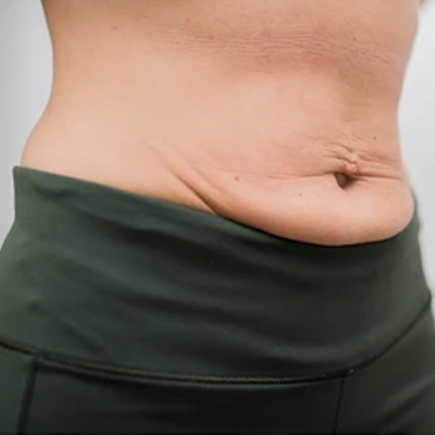 Bolsita  inferior del abdomen