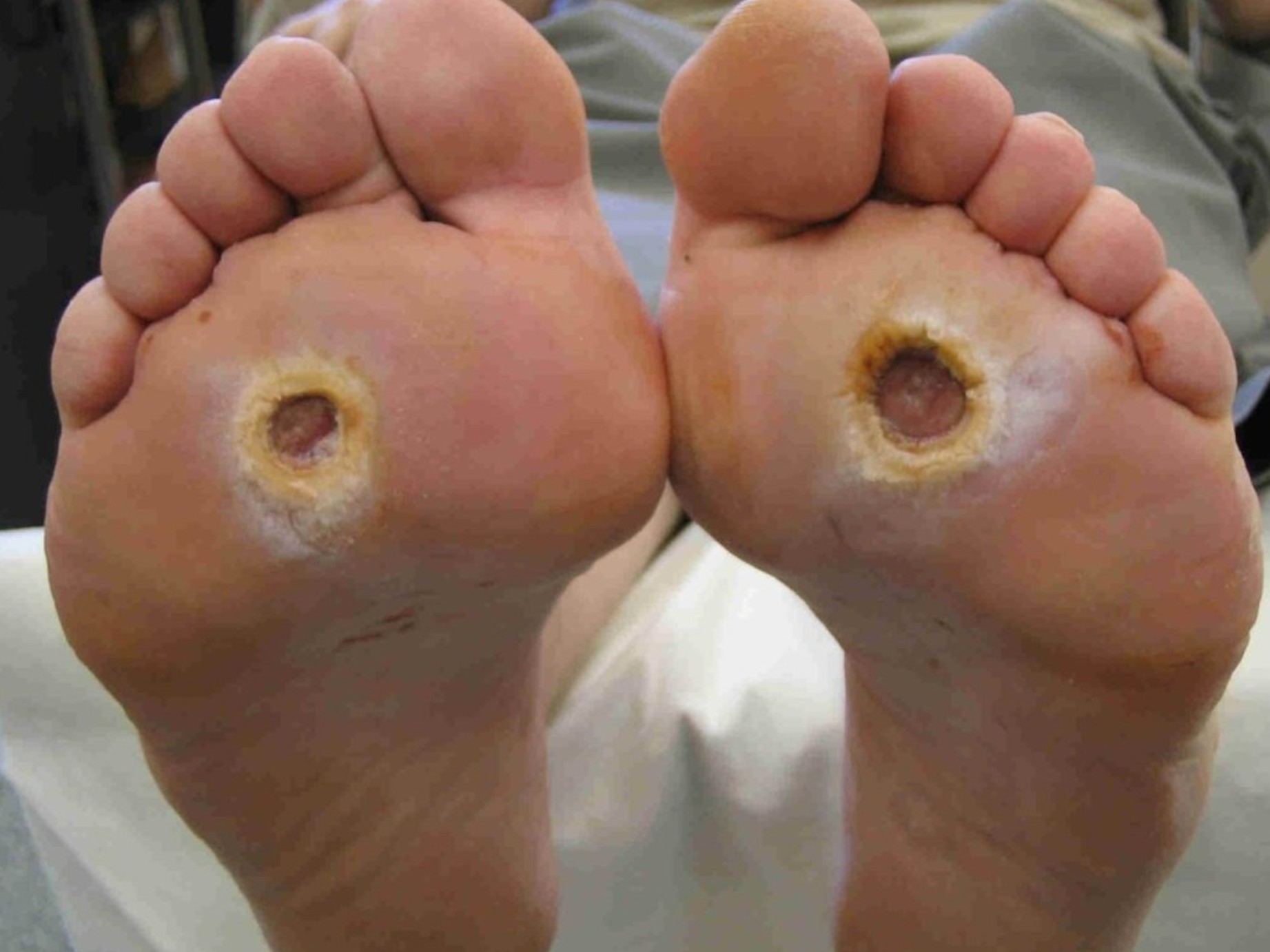 Ulcers and lacerations