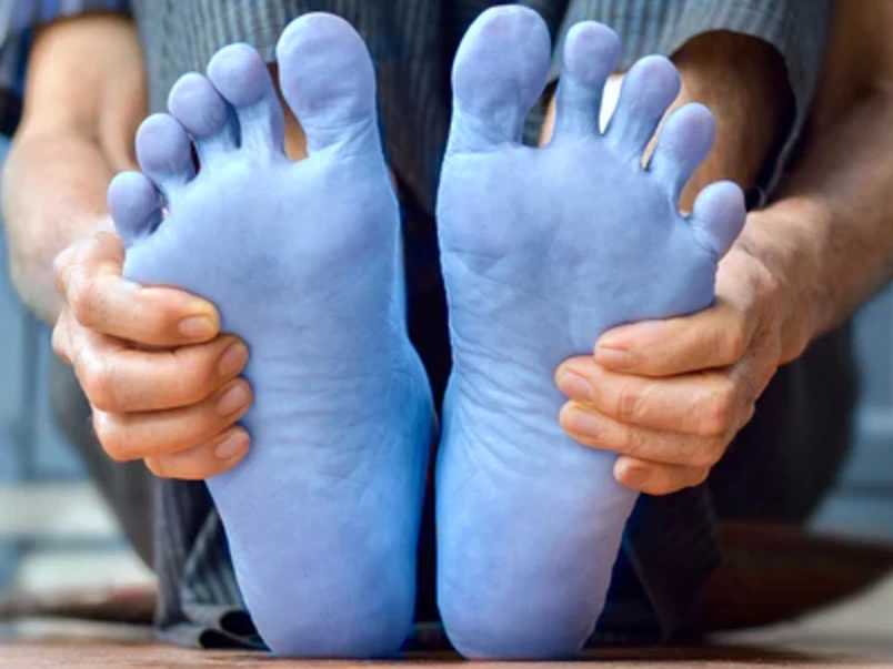 Extreme cold sensitivity - even in warm rooms