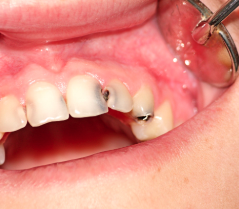 Severe - Multiple teethare badly affected