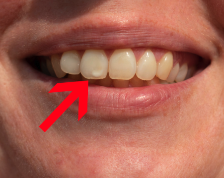 Mild - just a spot or slight discoloration