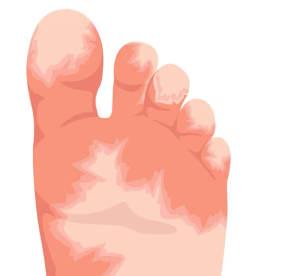 More persistent - dryness, cracking or discomfort multiple areas.
