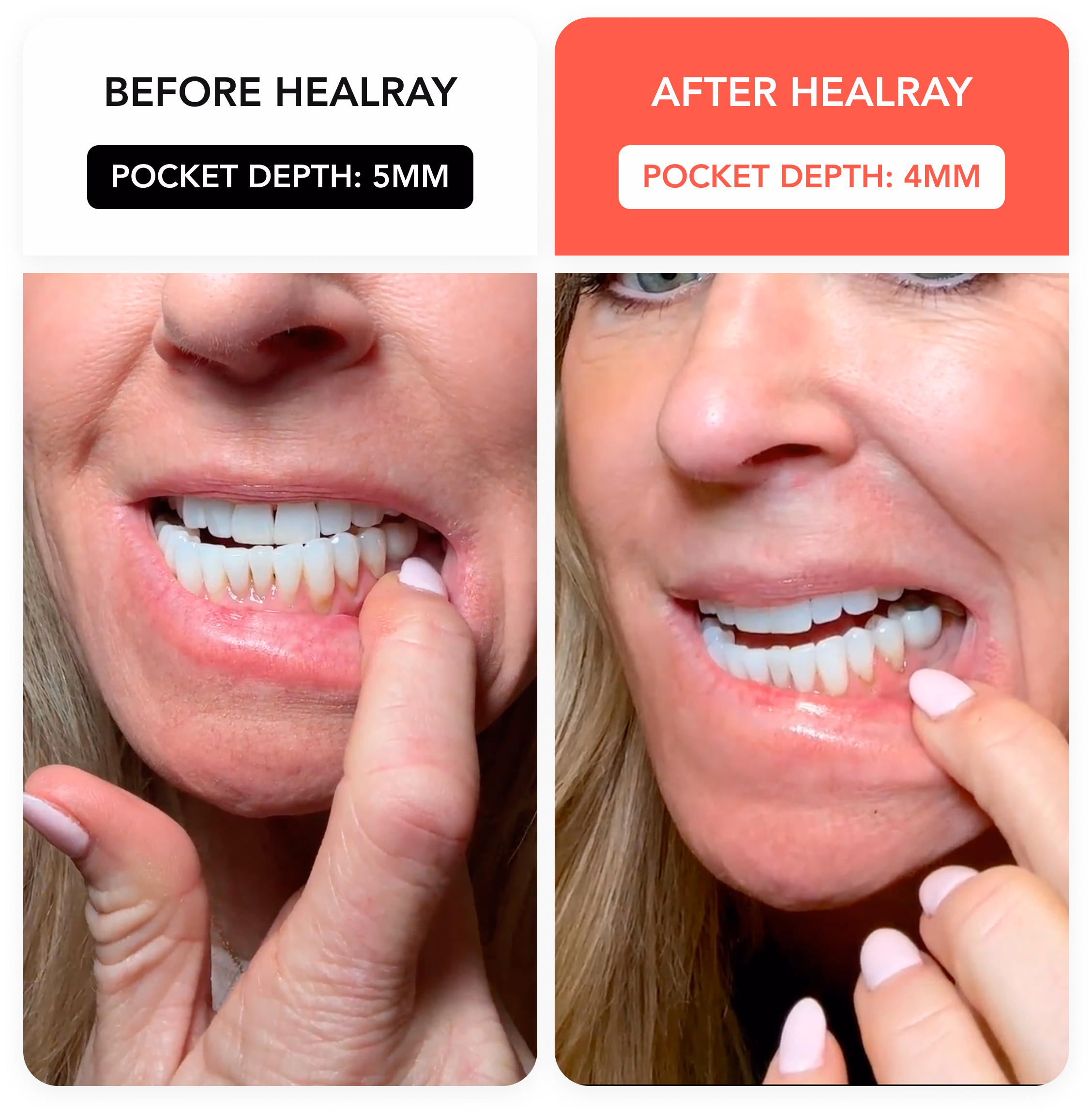 HealRay before and after result 4