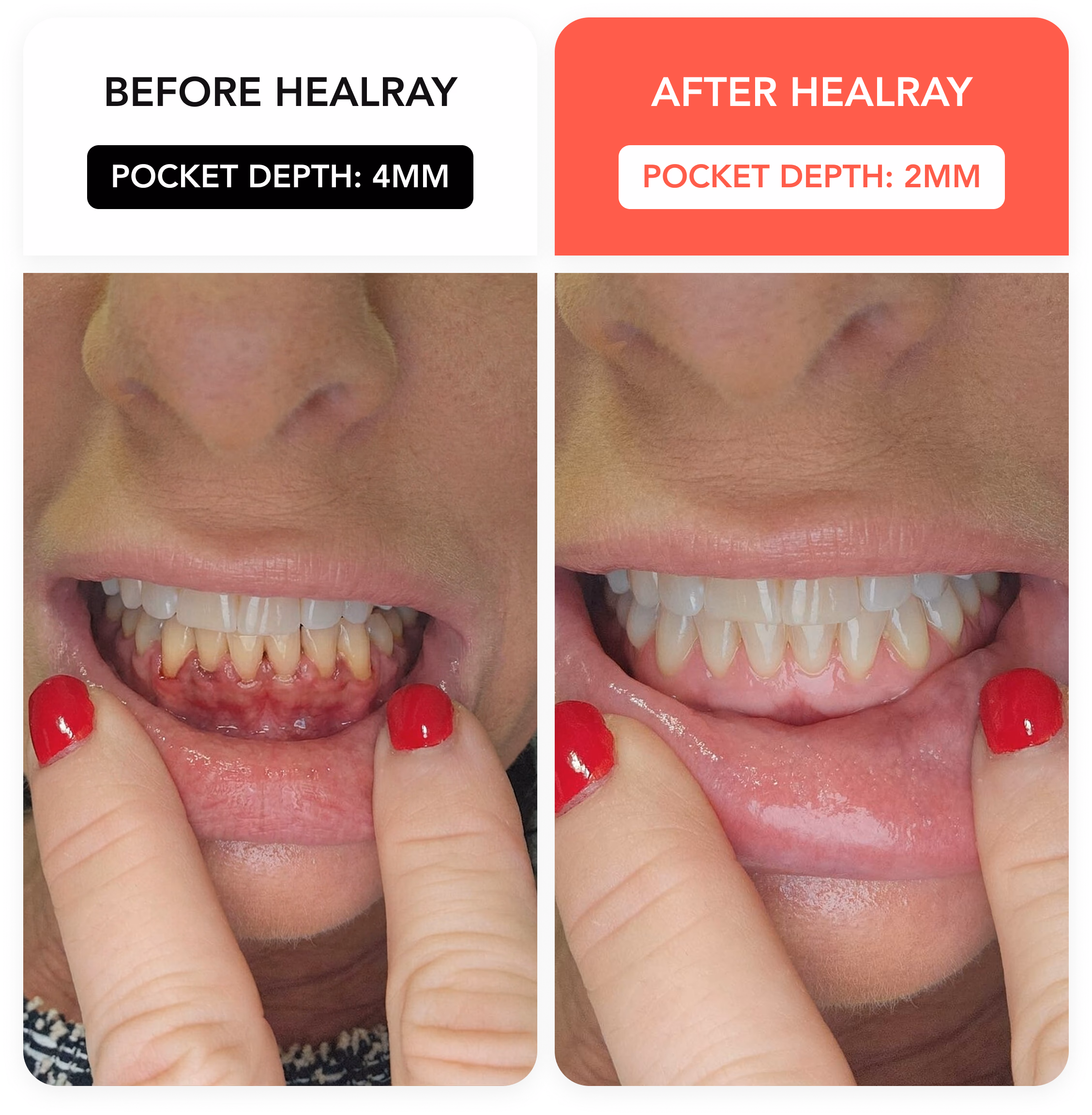 HealRay before and after result 1