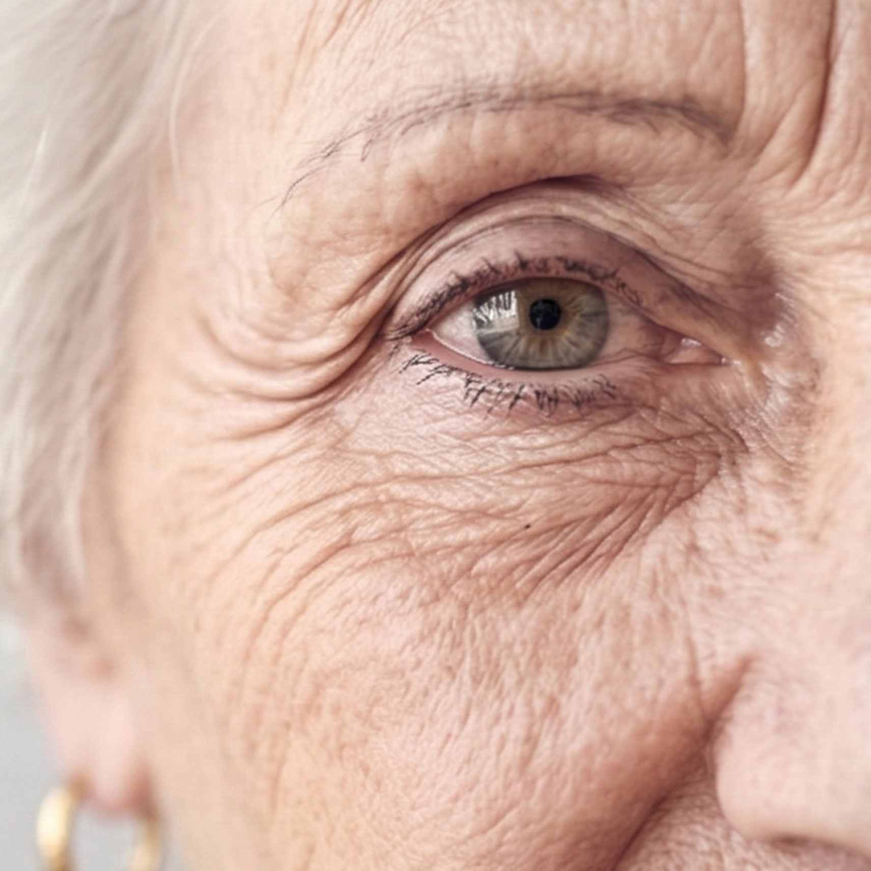 Eye Wrinkles or Crows Feet