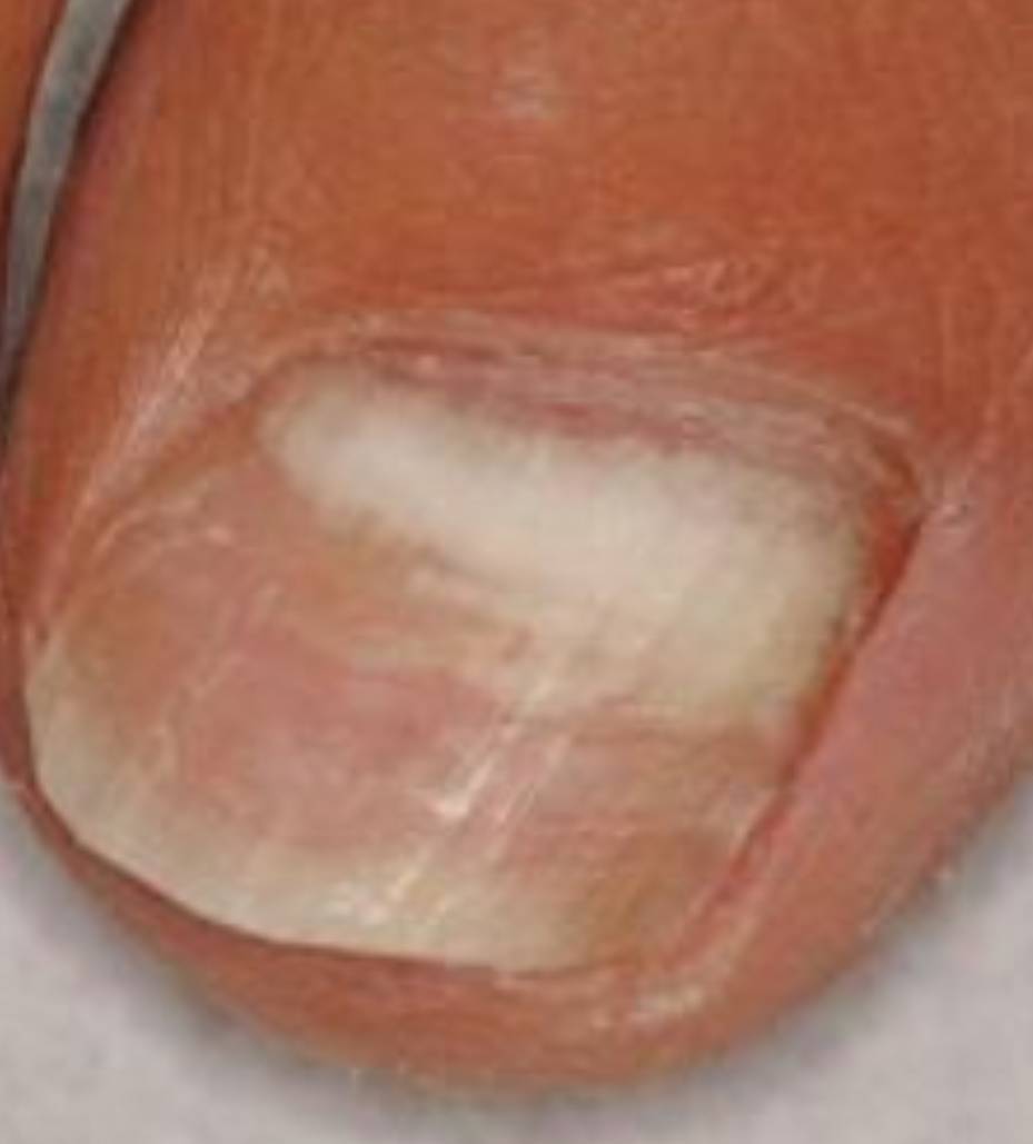 Mild – just a spot or slight discoloration