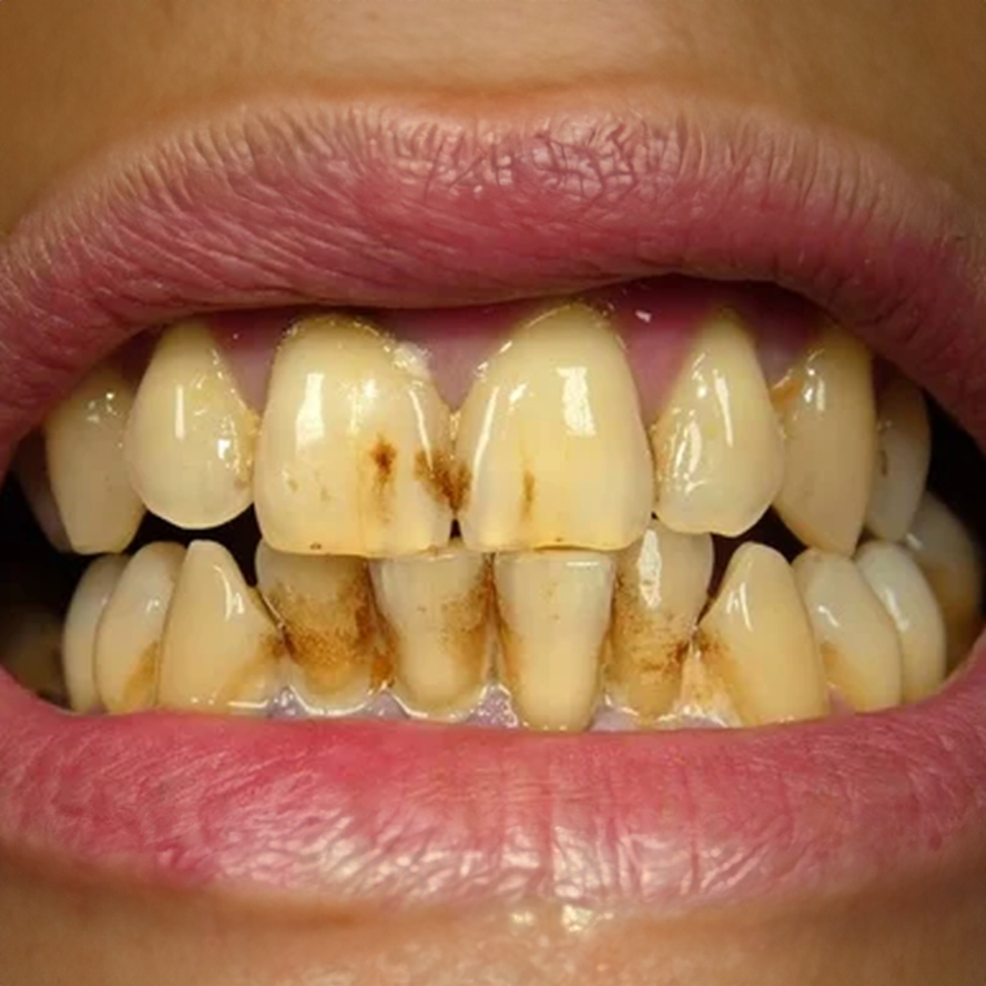 Yellow or stained teeth
