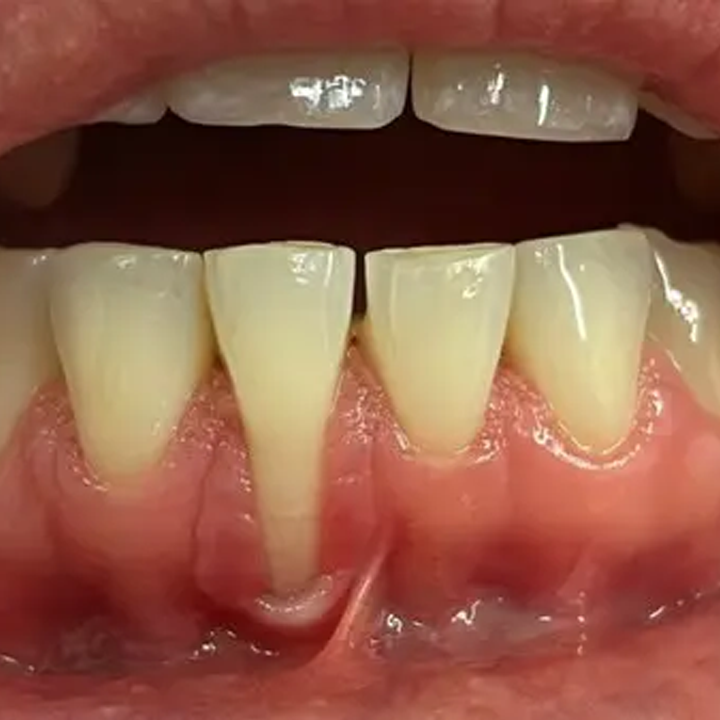 Receding gums