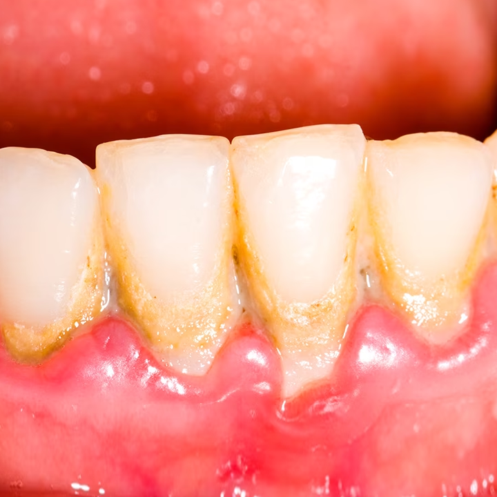 Plaque buildup