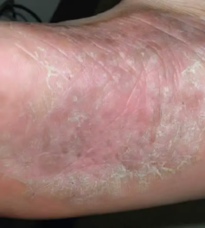 Enrojecimiento o irritación en las plantas de los pies
