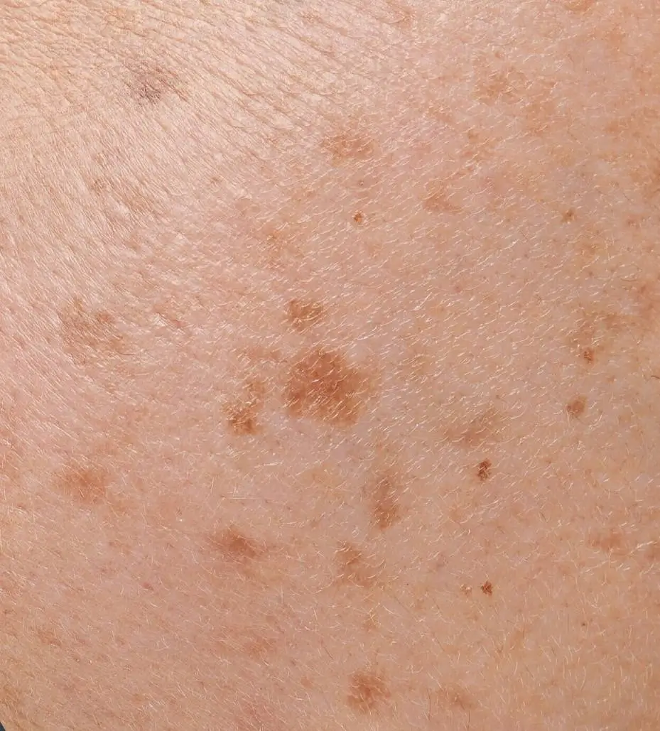 Mild – just a small spot or light discoloration