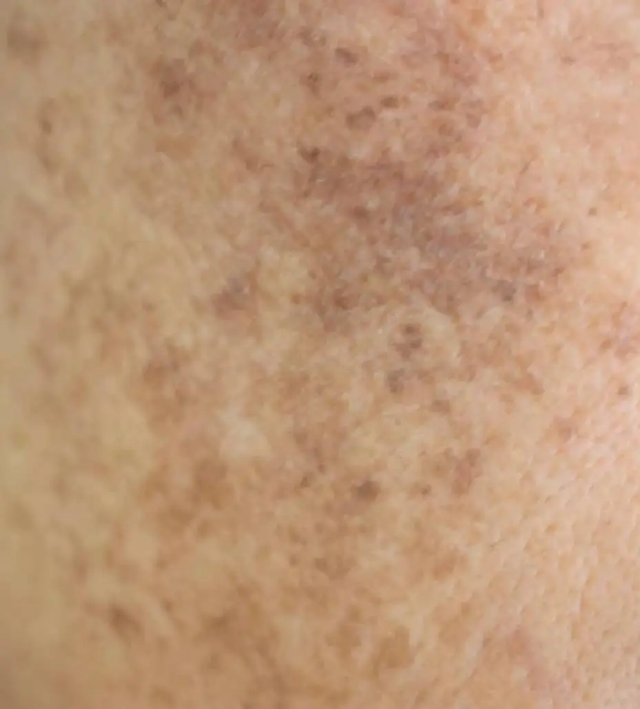 Moderate – clearly visible or spreading spots