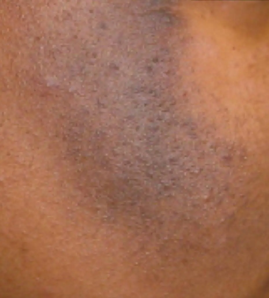 Severe – multiple large or deeply pigmented spots