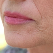Mouth Wrinkles
