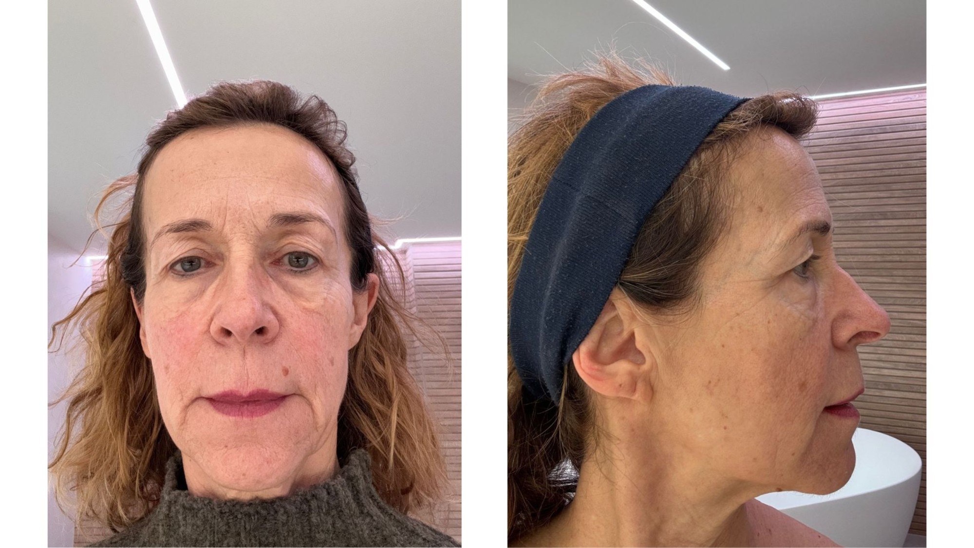 Frontal | Seitlich