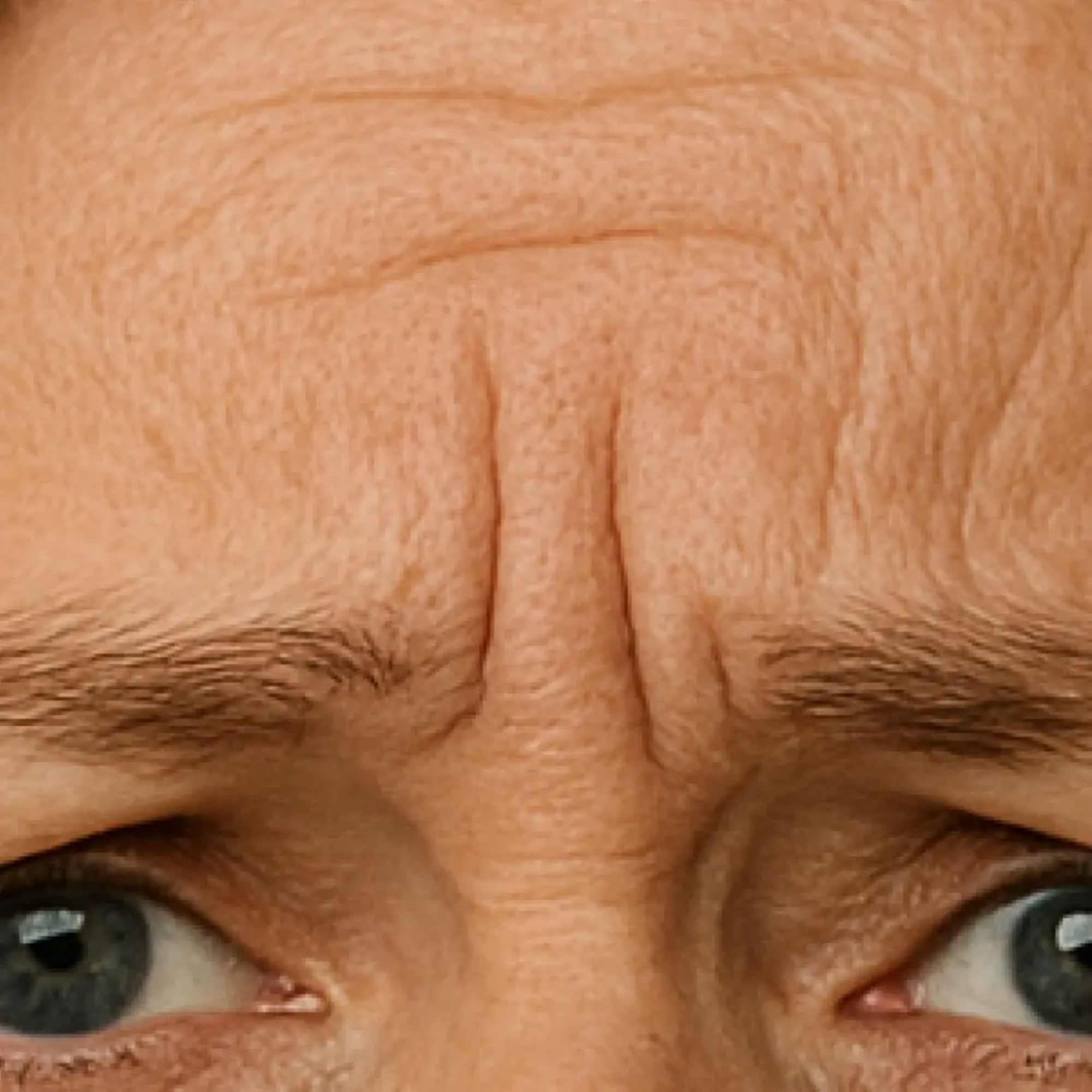 Forehead and frown lines