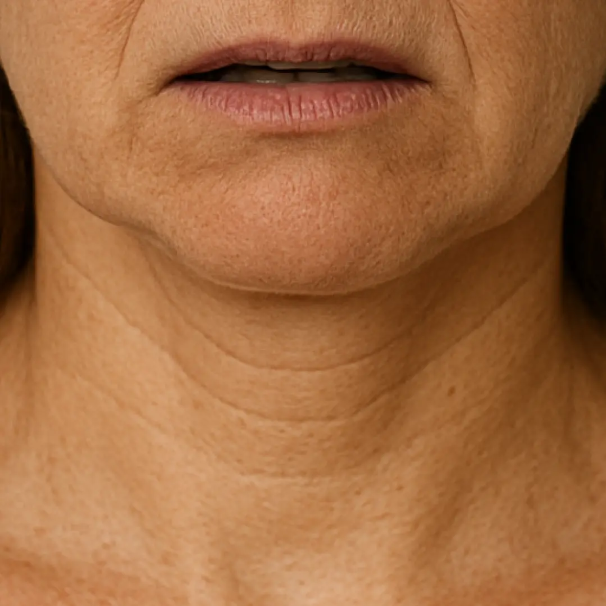Neck and chest aging