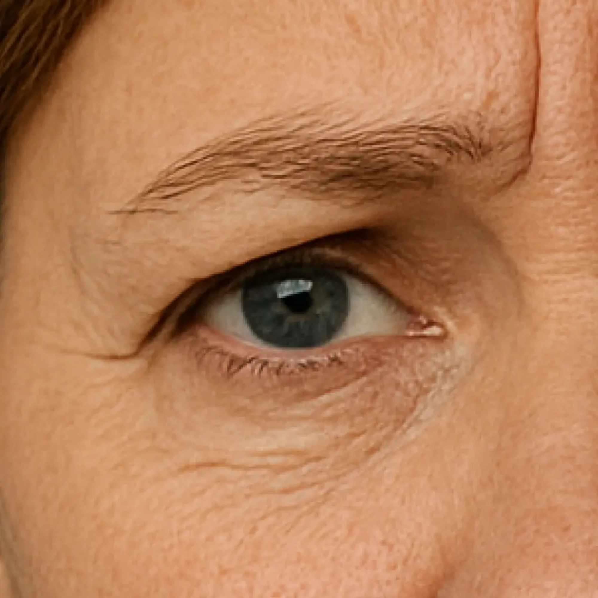 Around my eyes (crow's feet, bags)