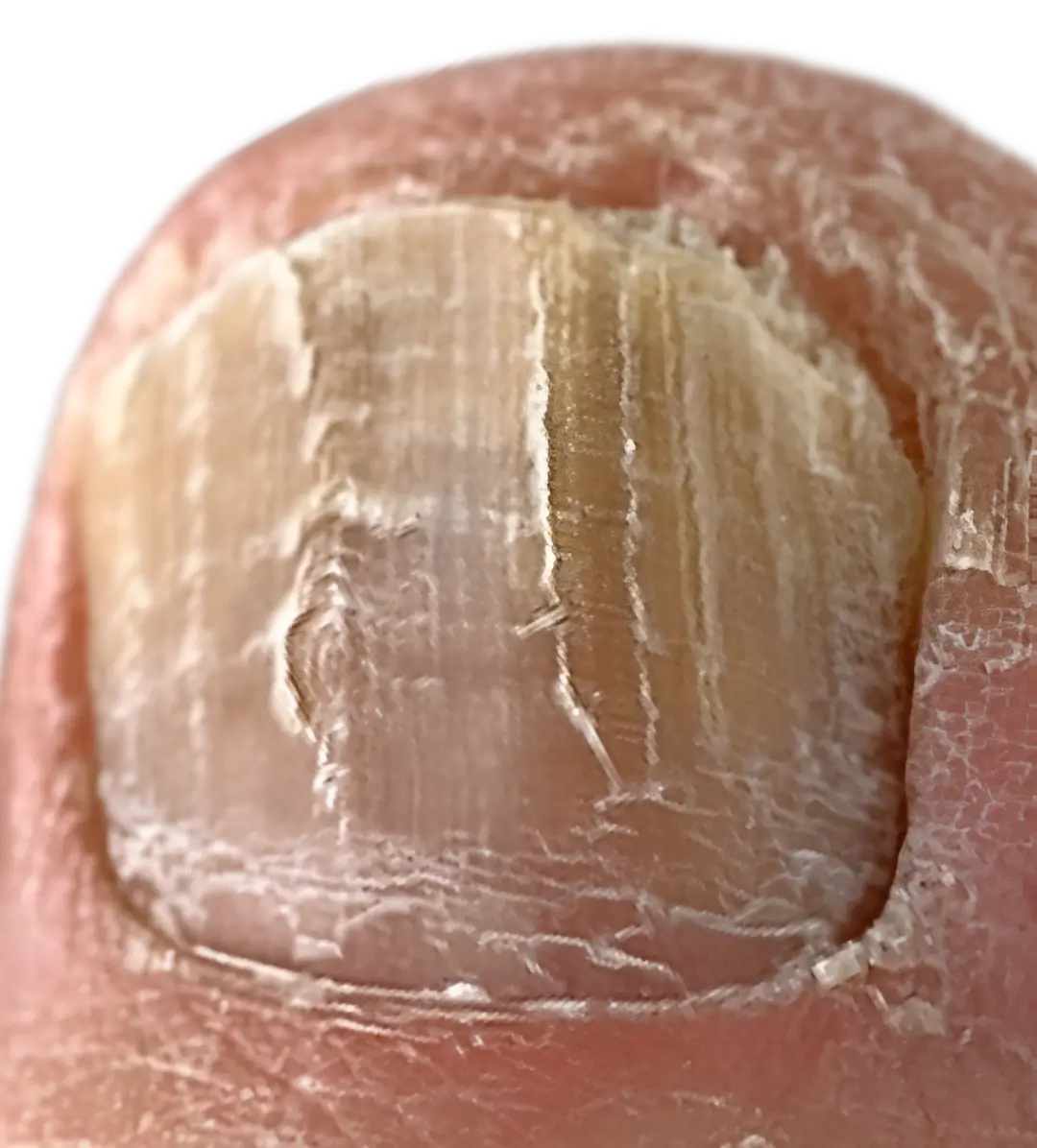 Thickened or brittle nails
