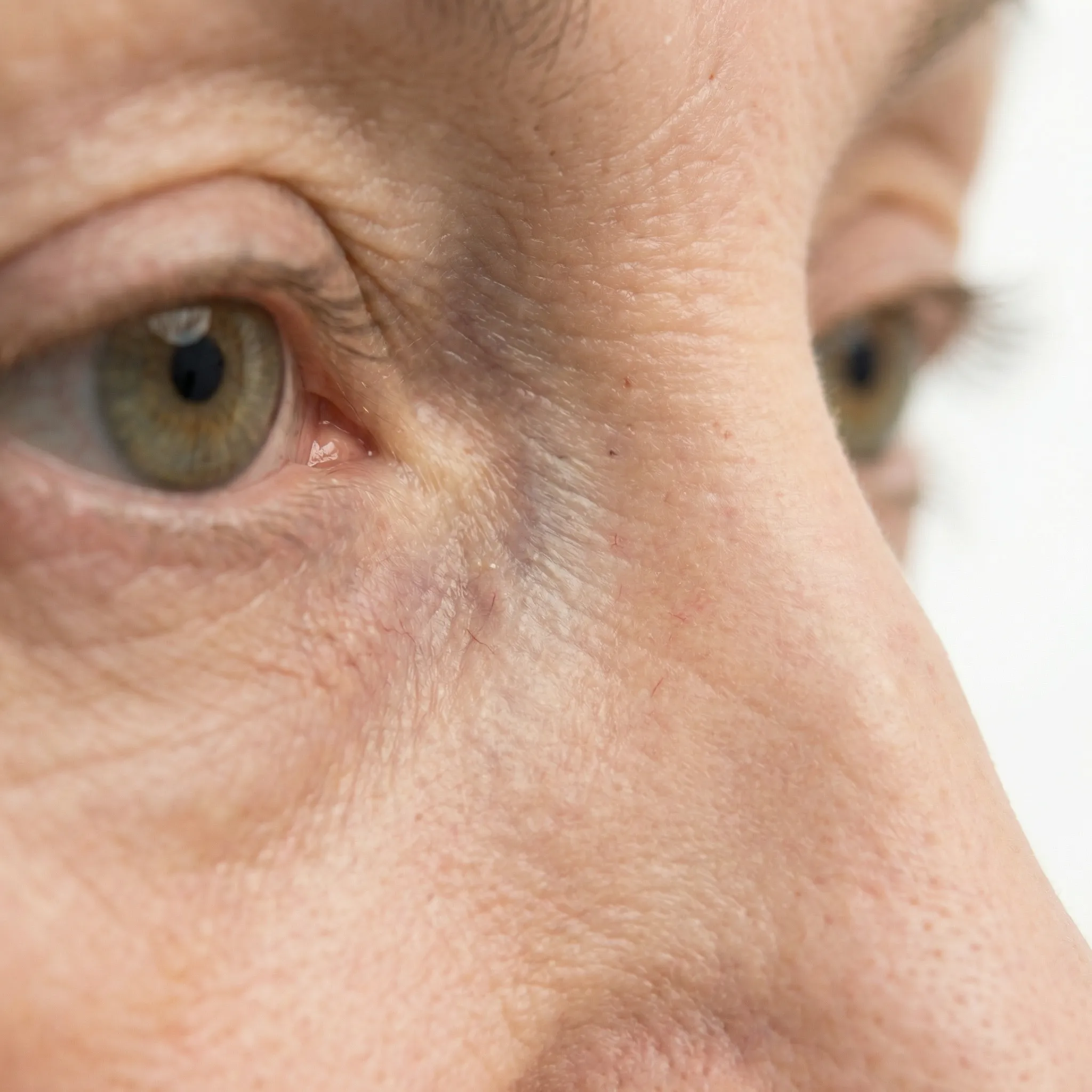 Under-Eye Hollows