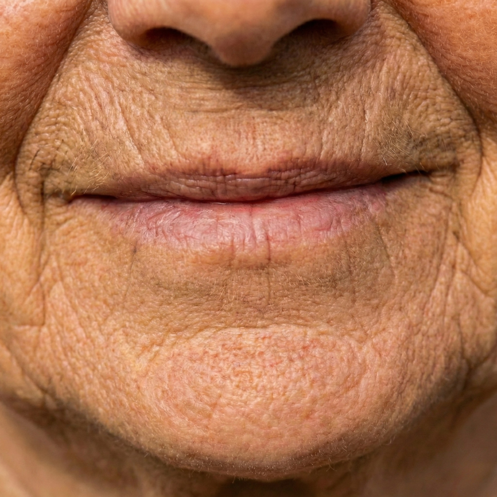 Mouth wrinkles