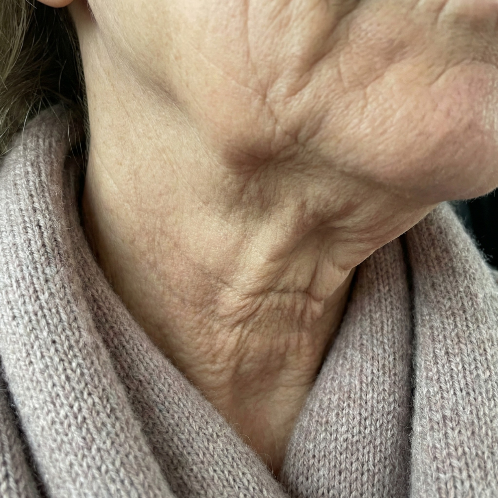Neck wrinkles & sagging jawline