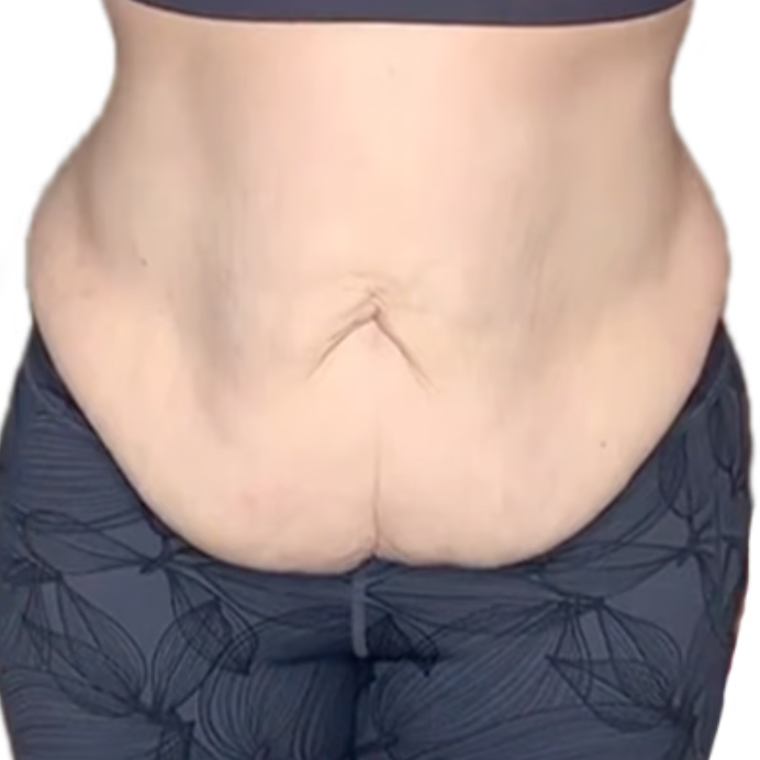 Severe Horizontal Loose Skin