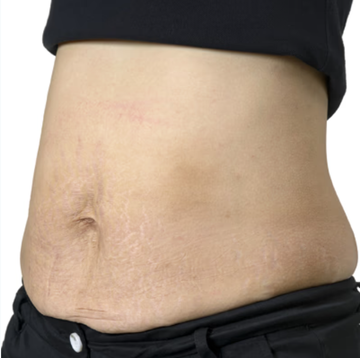 Horizontal Loose Skin