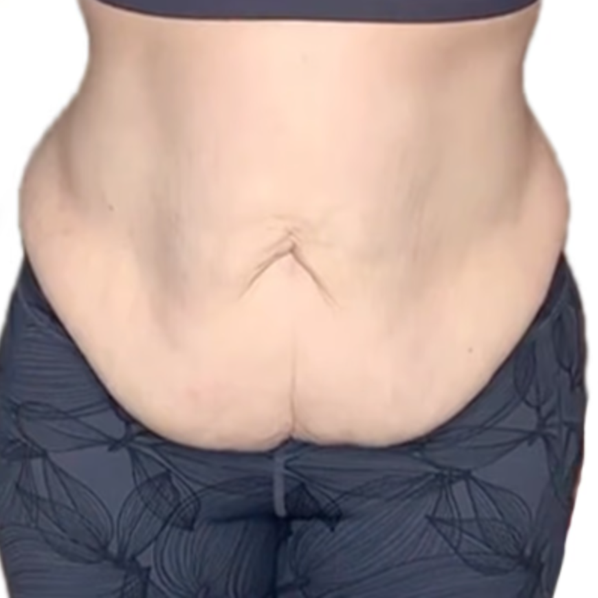 Lower Loose Belly Fat