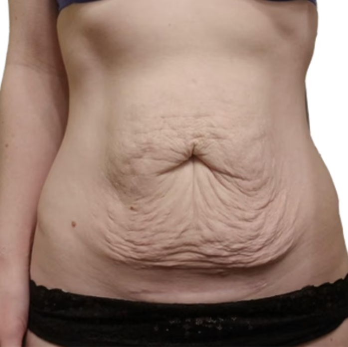 Severe Wrinkled Loose Skin