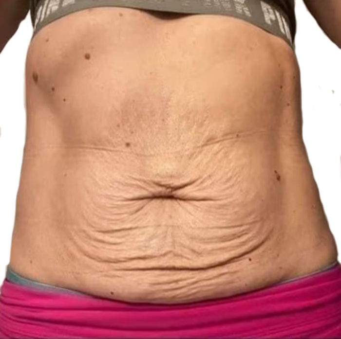 Mild Losse Skin