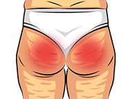 Fesses