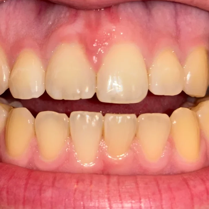 Yellow/Stained Teeth