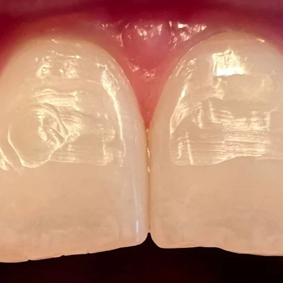  Weak/Damaged Enamel